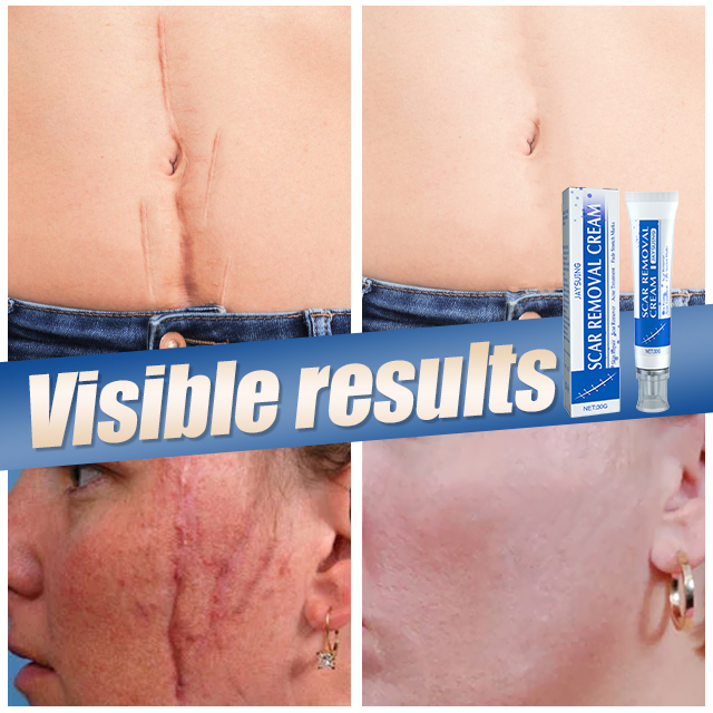 【Buy 1 free 1】Scar lightening repair cream【You can see noticeable results in just 7 days！】